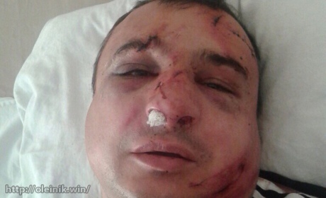 В киевском ресторане жестко избили луганского сепаратиста Клинчаева