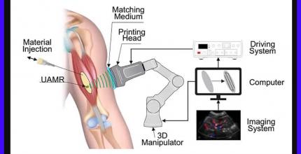 Учені Університету Конкордія змоделювали як нову технологію 3D-друку можна використати для створення імплантату в руці пацієнта